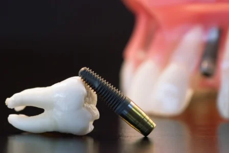 Dental Implants: Is It The Right Choice For You?