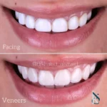 Dr khaled al sayed dental veneer case