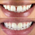 A case for Dental veneers in amman clinic