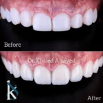 Detal Veneers teeth before and after