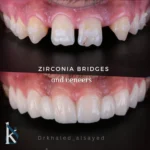 Dentist khaled al sayed making dental veneers