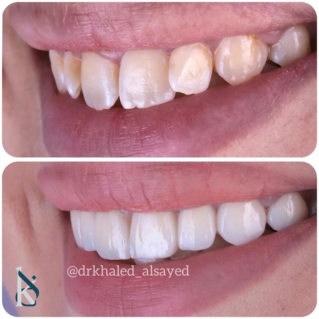 veneer case before and after
