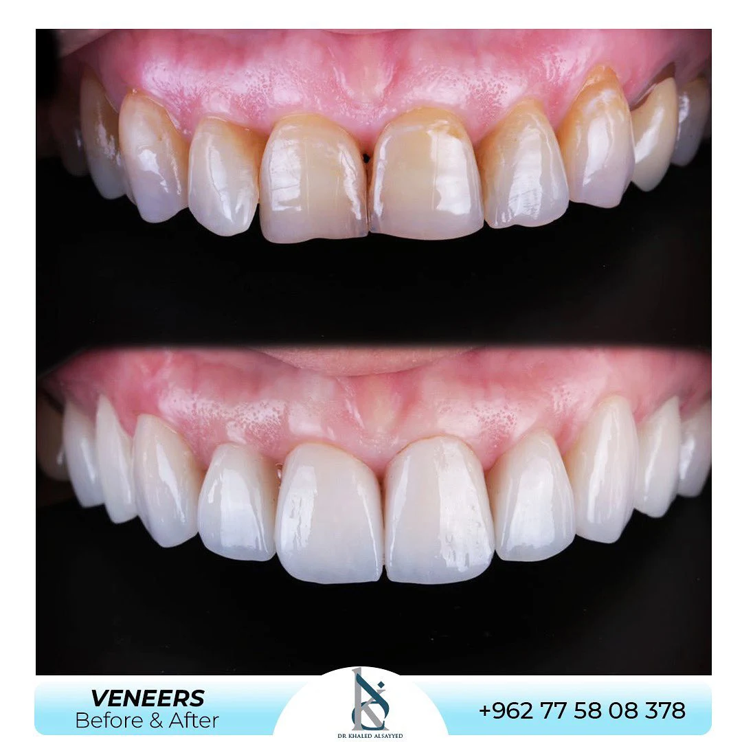 veneer teeth before and after case