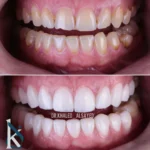 dental veneers teeth treatment in jordan