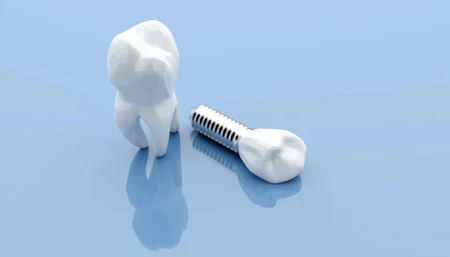 Dental Implants: Is It The Right Choice For You?