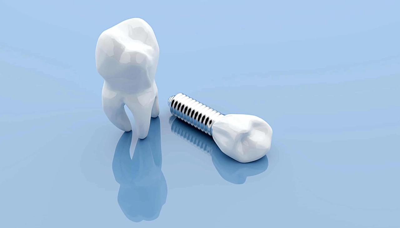 Dental Implants for Single Tooth