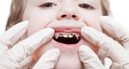 Children teeth dentist in amman jordan