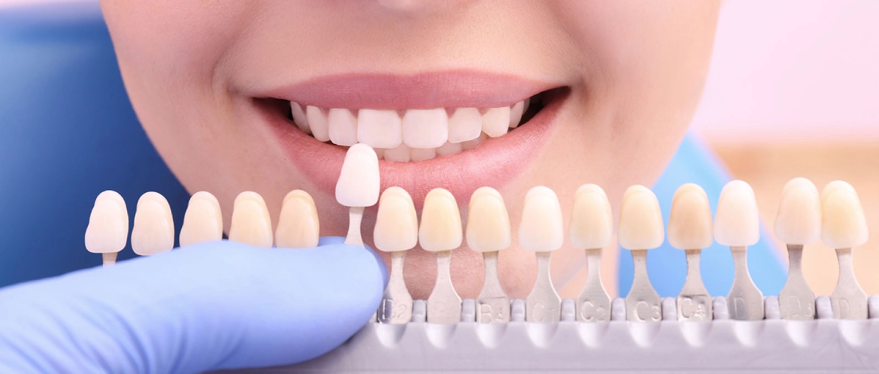 picking the right dental veneer color