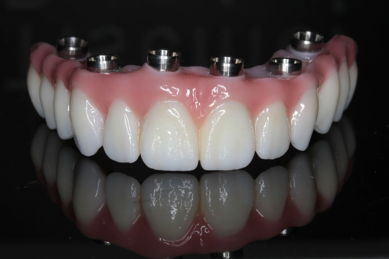 Smile Restoration with Full Mouth Dental Implants