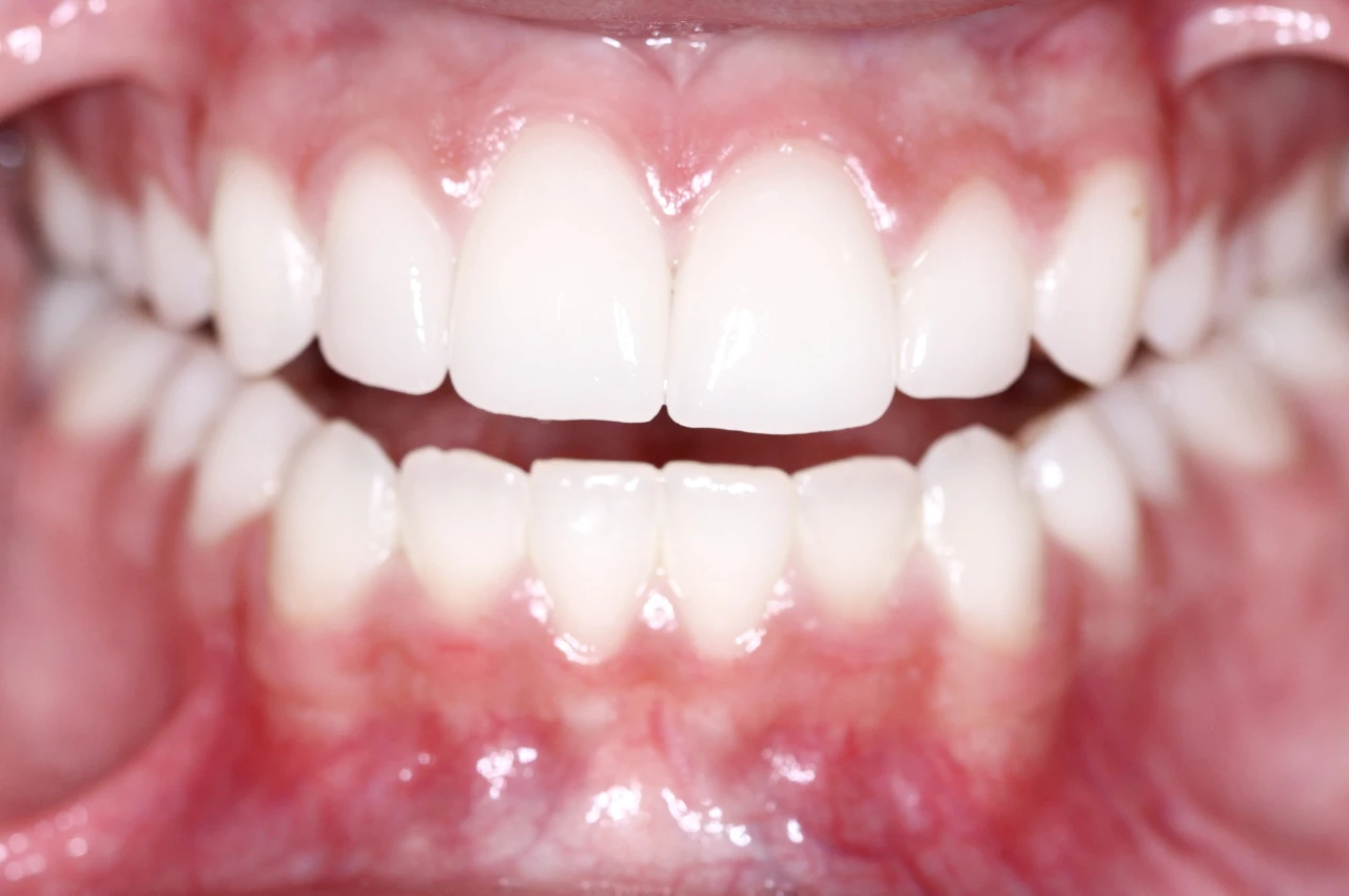 Gummy Smile Surgery options presented at Dr. Khaled Al Sayed’s clinic in Amman, Jordan with visuals of techniques