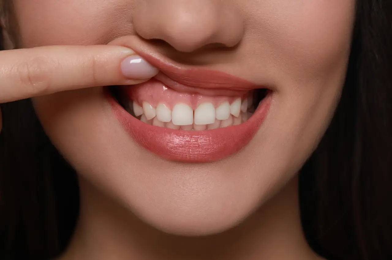 Infographic explaining the causes of a Gummy Smile including jaw shape and lip movement.