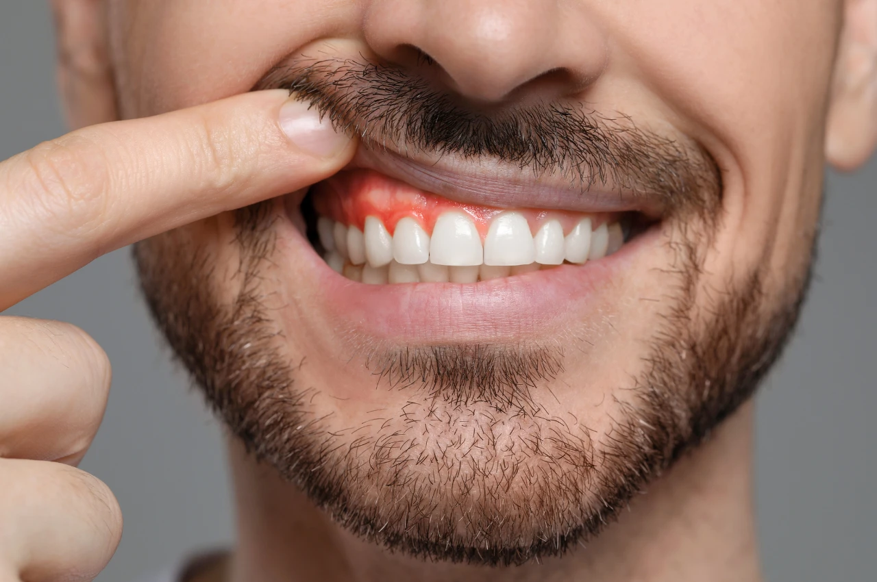 Gummy smile botox step-by-step procedure at Dr. Khaled Al Sayed’s clinic in Amman, Jordan