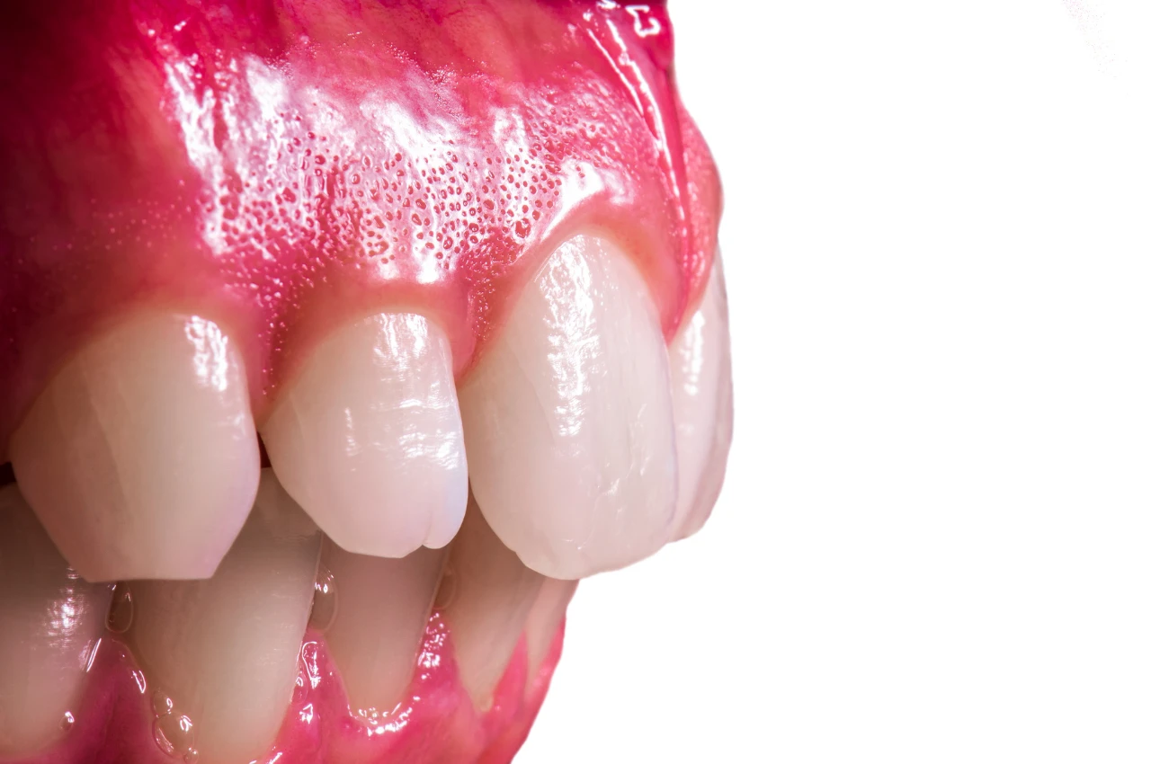 Gummy smile botox benefits explained at Dr. Khaled Al Sayed’s clinic in Amman, Jordan