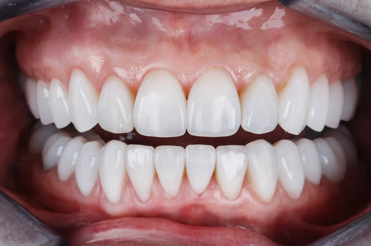 Images of cosmetic procedures used to correct a Gummy Smile, including laser gum contouring and Botox.