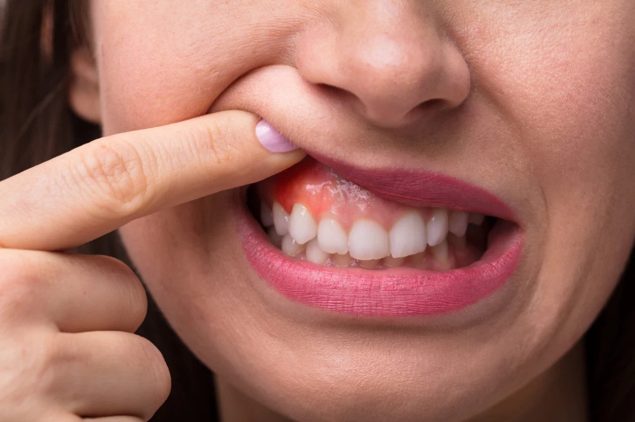 Gummy Smile Surgery performed by Dr. Khaled Al Sayed in Amman, Jordan to reduce excessive gum display