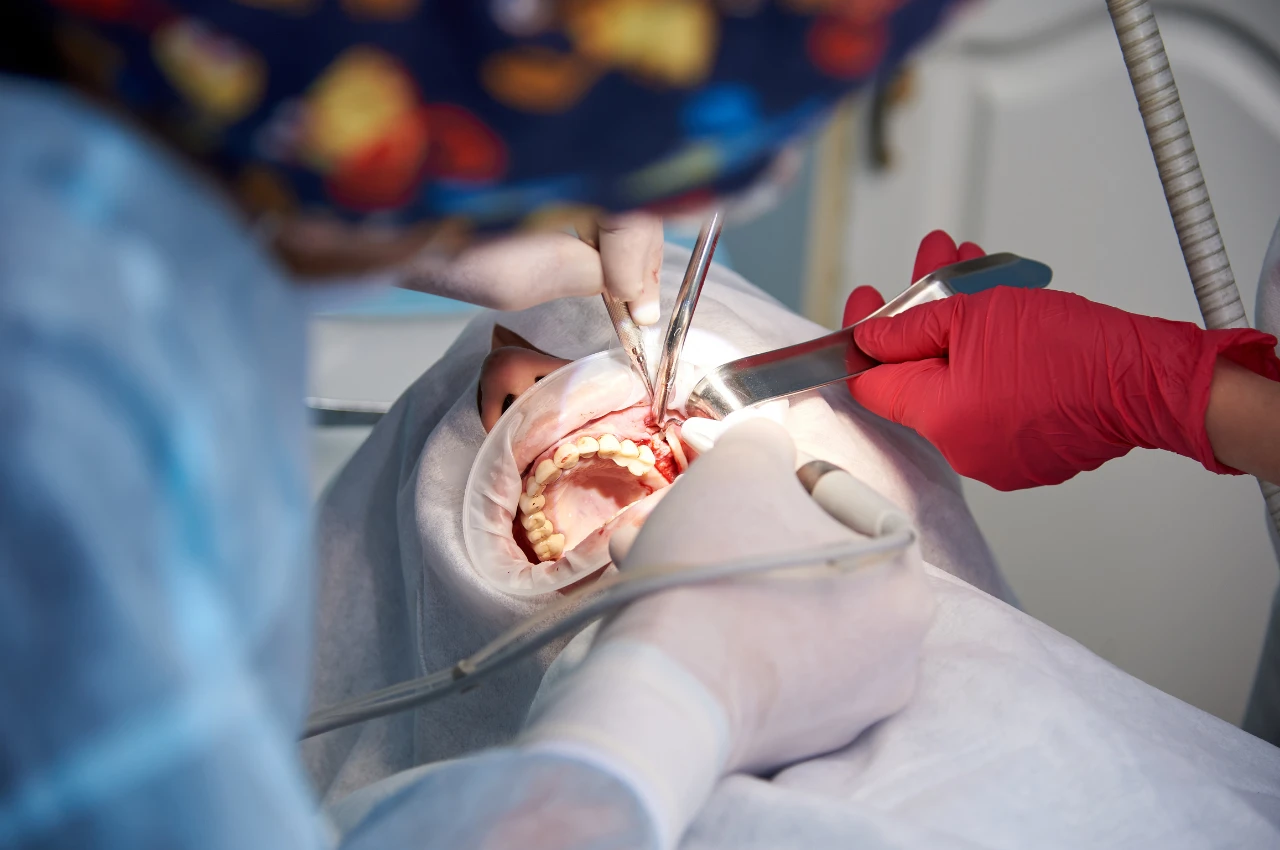 Gummy Smile Surgery consultation with Dr. Khaled Al Sayed in Amman, Jordan explaining causes of gum excess